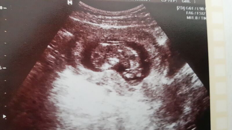 Datei:Fötus Embryo Ultraschall.jpg